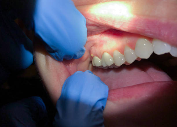 Best Emergency Dental Extractions in Forest Lake, IL