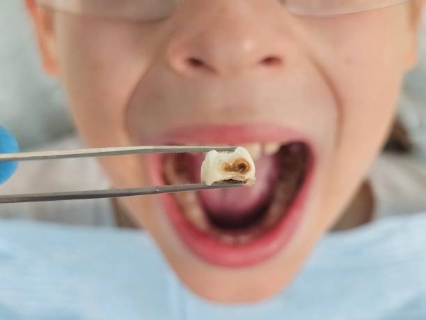 Best Emergency Dentist for Knocked-Out Tooth in Forest Lake, IL