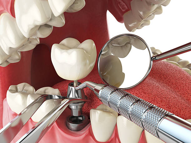 Best Emergency Dentist for Knocked-Out Tooth in Forest Lake, IL